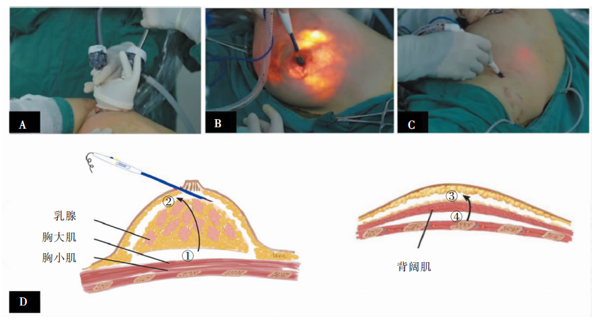 修正根治的乳房切除術と単純乳房切除術の比較